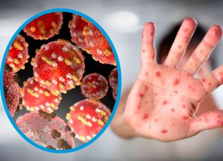 Salud: Alta alerta en Honduras por la viruela del mono