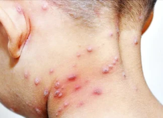 La OMS declara una emergencia sanitaria internacional por brote de mpox (antes viruela del mono)